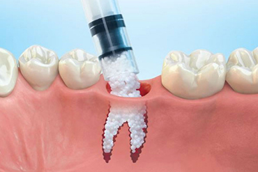 Receding gums